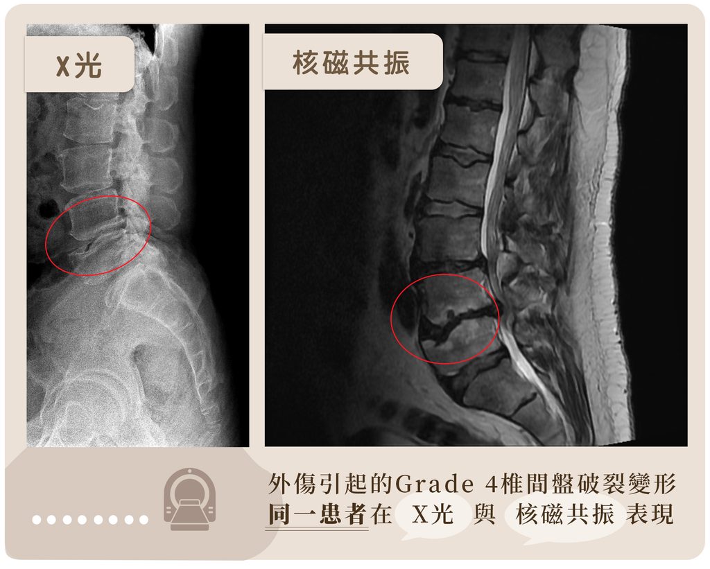 腰椎第四五結損傷在MRI與X-ray的顯像差別
