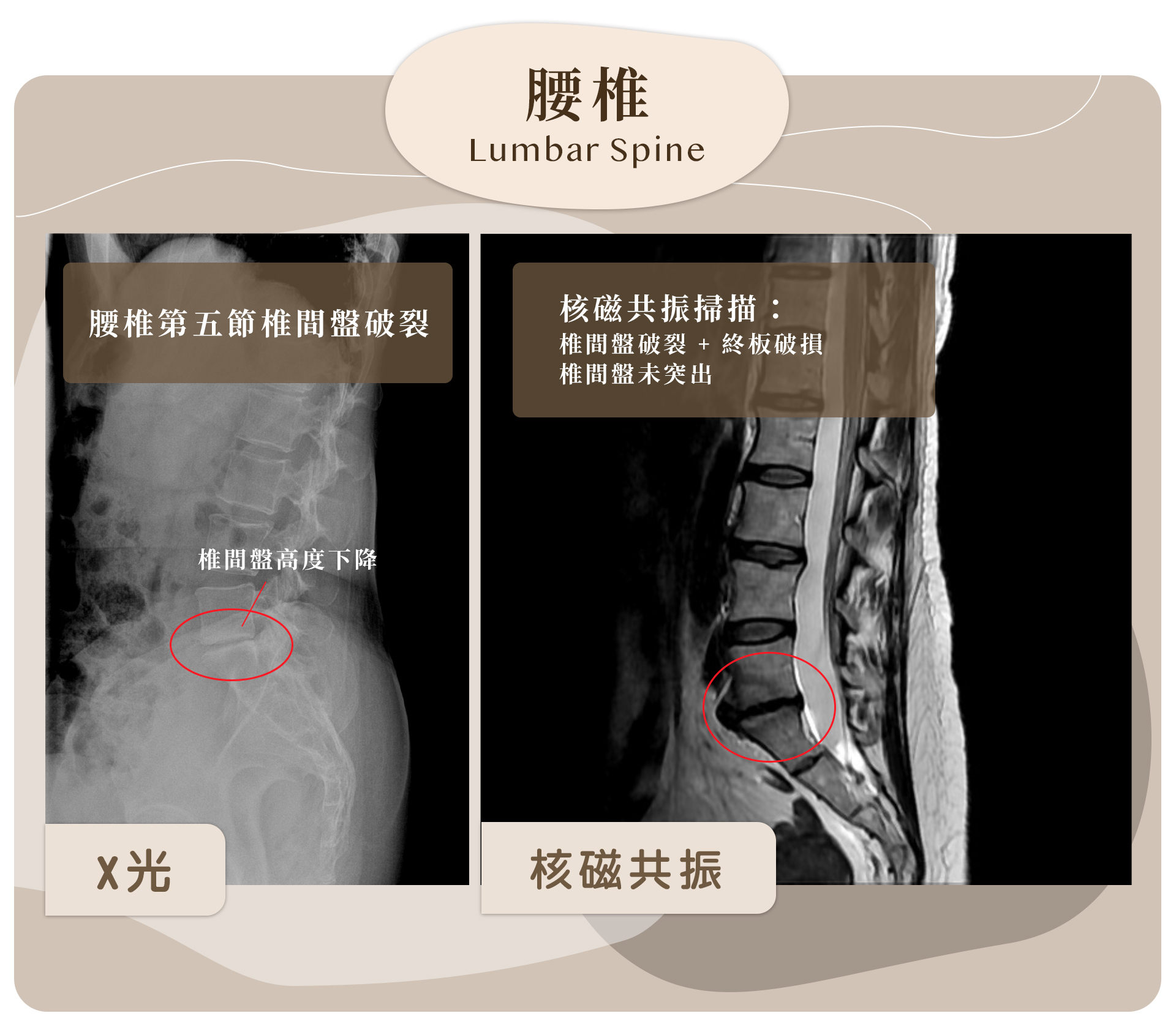 X-ray腰椎第五節椎間盤高度下降在MRI上的表現