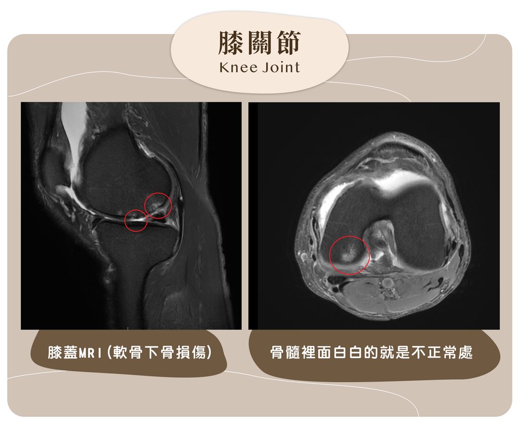 膝關節骨內損傷的MRI影像