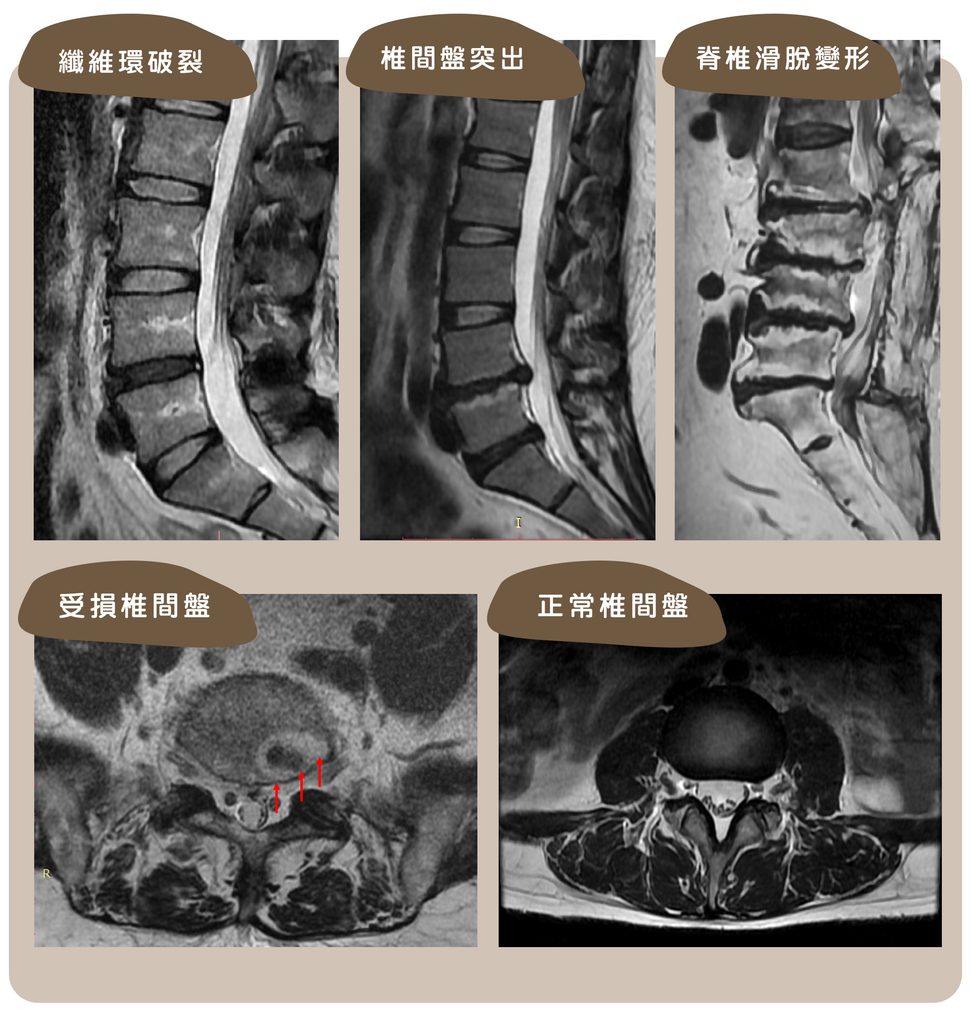 椎間盤破裂椎間盤突出腰椎退化與正常椎間盤的MRI影像比對