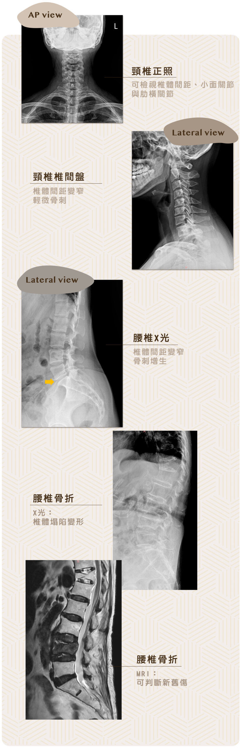 頸椎腰椎X光與腰椎骨折
