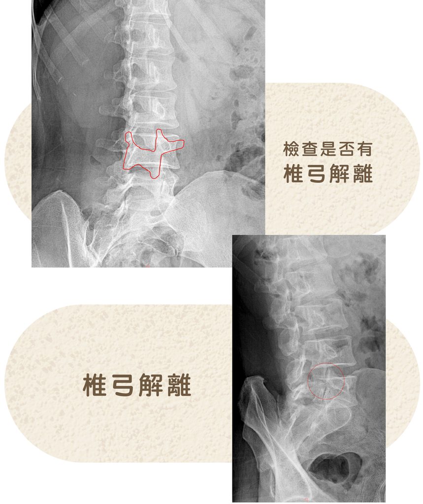 spondylolysis-image-oblique