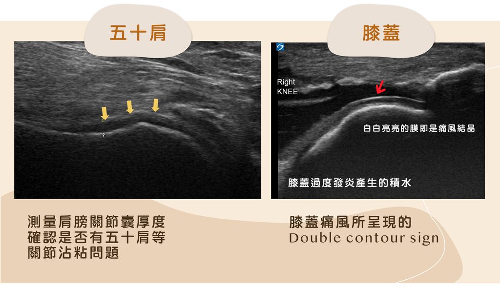 膝蓋痛風與五十肩的超音波影像