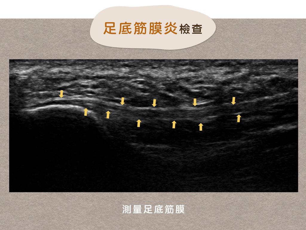 足底筋膜的超音波影像